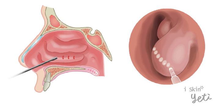 黏膜下穿刺，減少流鼻水