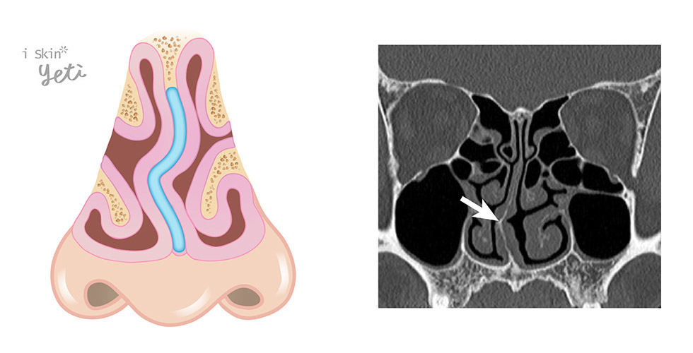 鼻中隔彎曲常合併肥厚性鼻炎