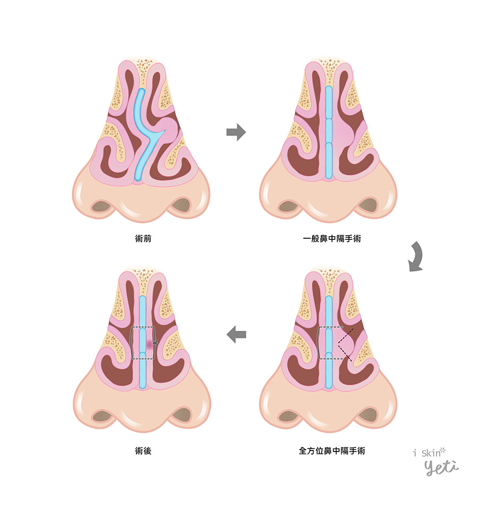 全方位鼻中隔術