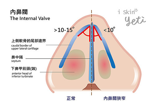 內鼻閥塌陷