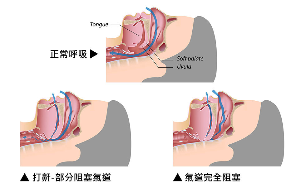 圖示正常呼吸/ 打鼾之差異