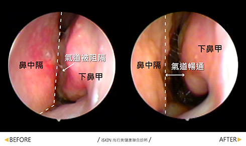 鼻塞治療案例NO.11389就診時，鼻塞完全不通，因長期鼻塞導致嚴重頭痛與失眠。鼻內視鏡檢查發現左側的鼻中隔彎曲加上下鼻甲肥厚，兩者幾乎靠在一起，沒有氣流的空間。經鼻道鼻中隔成型手術及下鼻甲廣達雷射手術治療後，整個氣道通暢。鼻塞患者術前的問題都解決了。