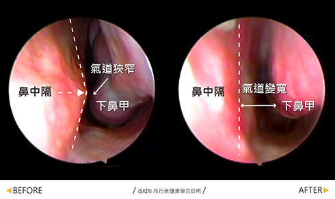 鼻塞治療患者原本鼻中隔彎曲與下鼻甲肥厚問題合併，因此多年來都有鼻塞、過敏、長期睡眠呼吸中止的問題，做了鼻中隔矯正加廣達光纖雷射縮小下鼻甲體積治療鼻塞後，已經明顯改善多年來的鼻塞問題，晚上的睡眠品質也更好了。